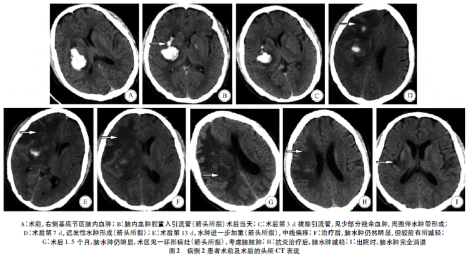 颅脑手术后迟发性脑水肿的临床分析临床神经外科