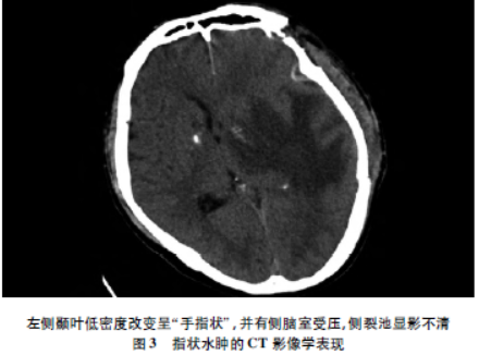 颅脑手术后迟发性脑水肿的临床分析临床神经外科