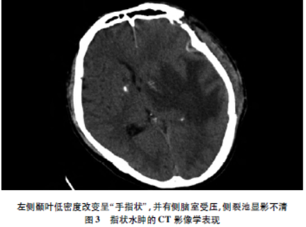 颅脑手术后迟发性脑水肿的临床分析|临床神经外科