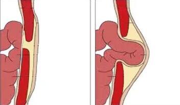 (疝气发生示意图)