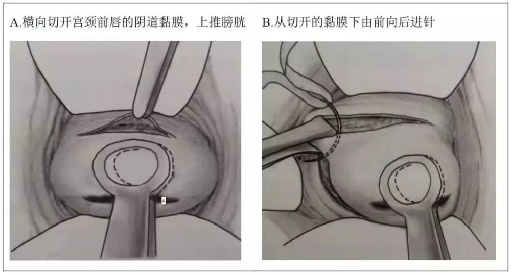 图解妇产实用技能:妊娠期宫颈环扎,你掌握了吗?