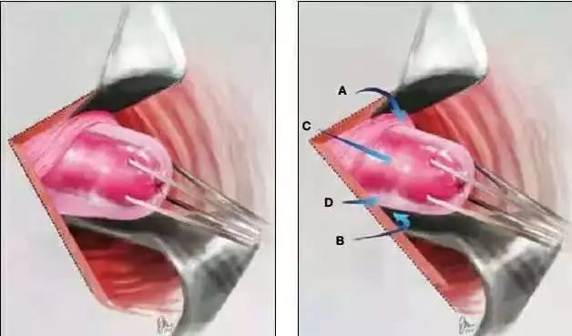 膀胱反折,b. 后穹窿; c. 宫颈间质; d.