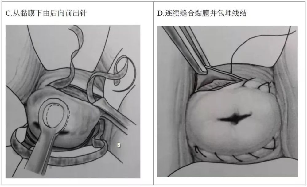 技巧:越接近宫颈内口位置(越高),环扎效果越好,进针时避免损伤膀胱