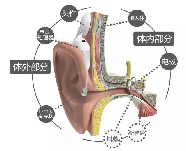 听力不好该选助听器还是人工耳蜗记住这4点找到最佳方法