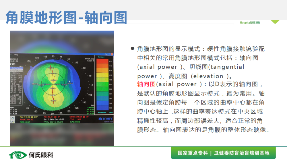 角膜地形图在塑形镜中的数据解读