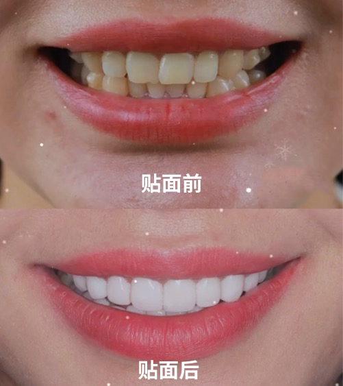 美白牙齿骗局还要坑多少人