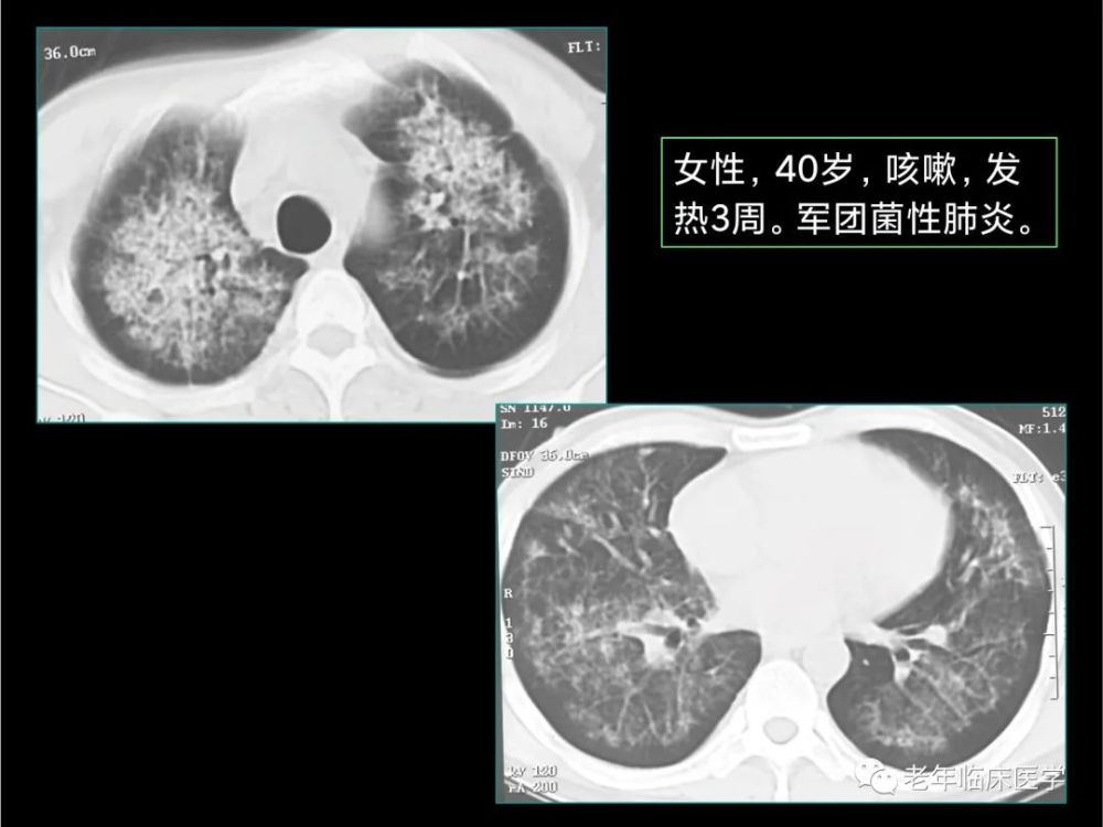 珍藏版(ct系列之二):肺部炎症性疾病