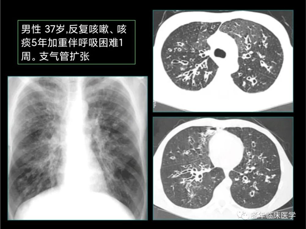 珍藏版(ct系列之二):肺部炎症性疾病