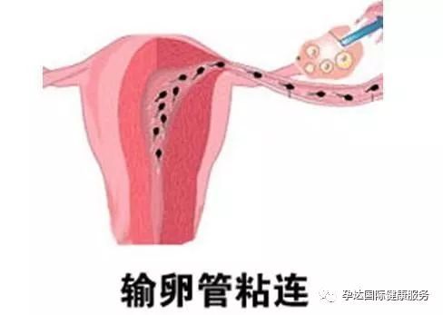 输卵管阻塞!什么情况下必须要做试管婴儿?