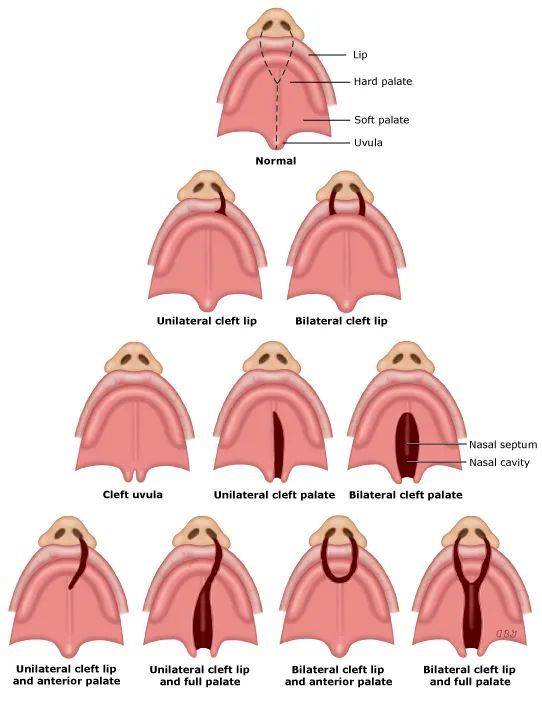 大多数唇裂婴儿也合并腭裂(85%的双侧唇裂和