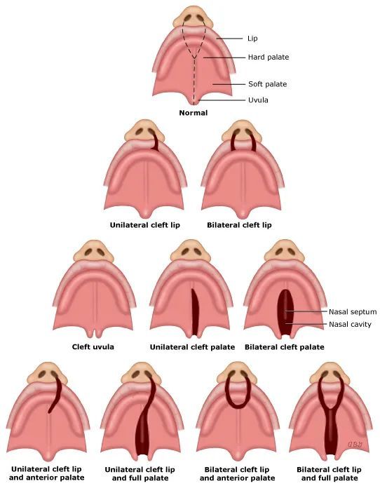 唇腭裂分类