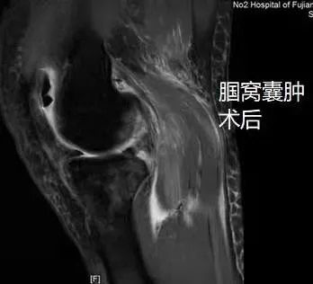 将腘窝囊肿切除.