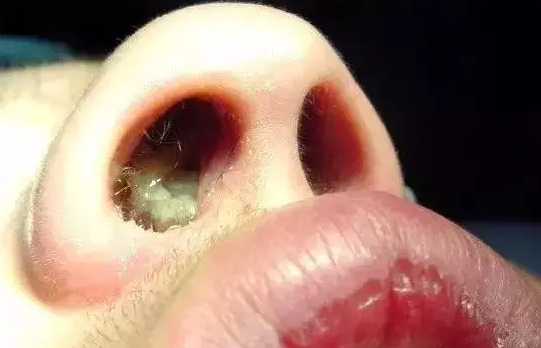 清的,白的,黄的……鼻涕颜色代表宝宝的健康状态,家长要懂辨别