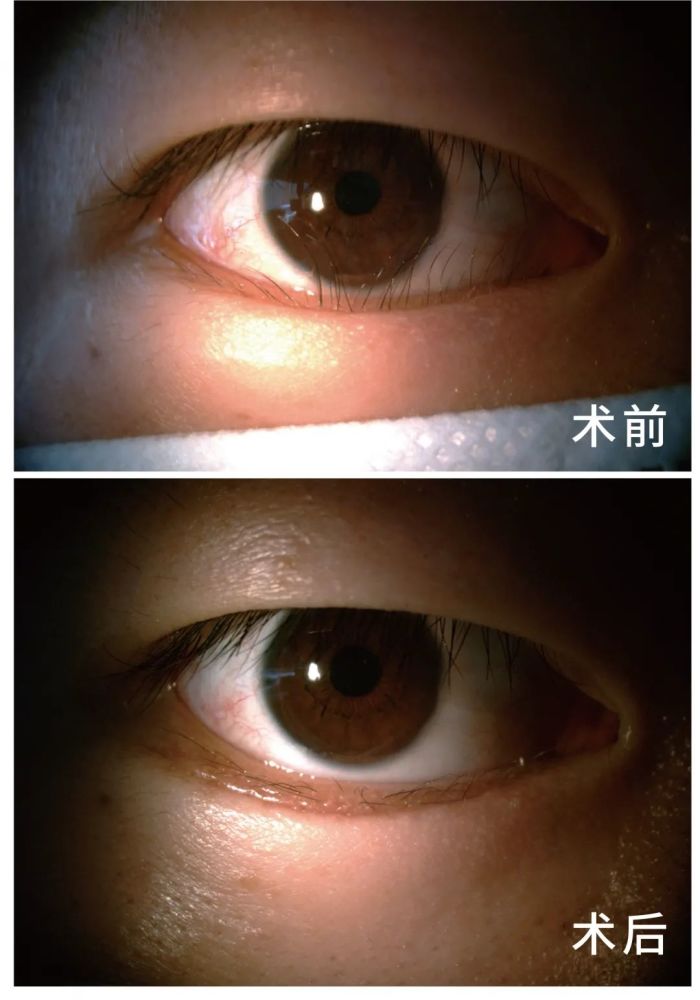 睫毛倒着长,能上手拔吗?
