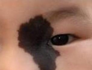 怀孕时这3种做法可能会让胎儿长胎记女性自己心里要有数