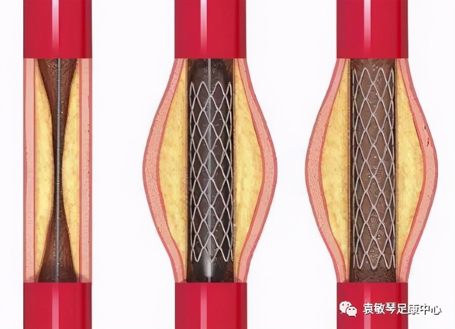 血管介入支架术示意图