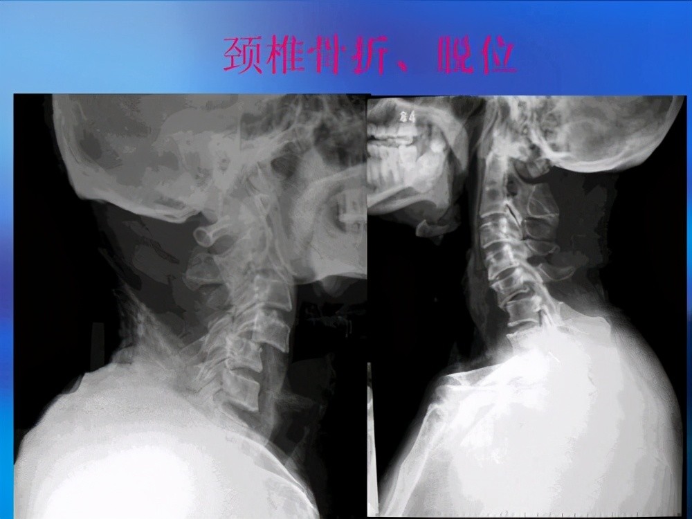 寰椎骨折脱位主要是外伤所致此病一般分为三种类型预后良好