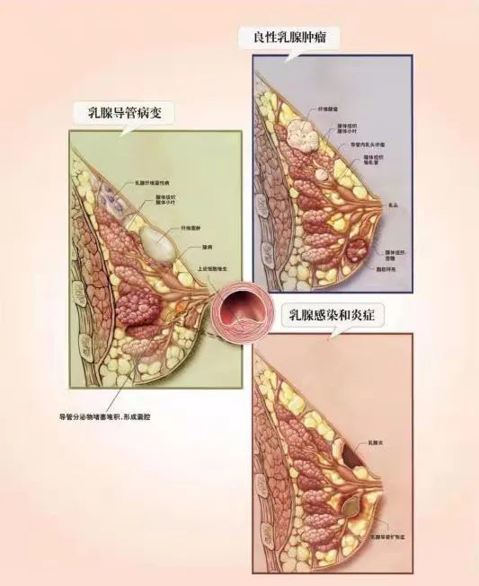 关注好消息福清市妇幼保健院推出乳腺疾病治疗新技术
