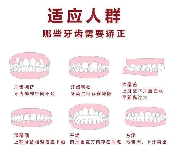牙齿矫正知多少?