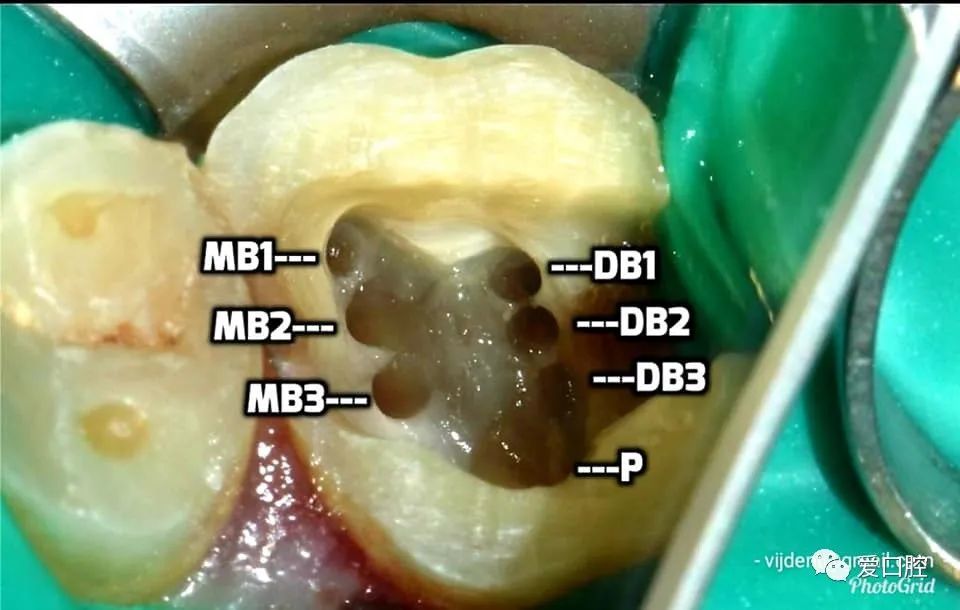 粘结修复1例下颌第一磨牙完整根管治疗1例#36根管治疗 树脂充填1例