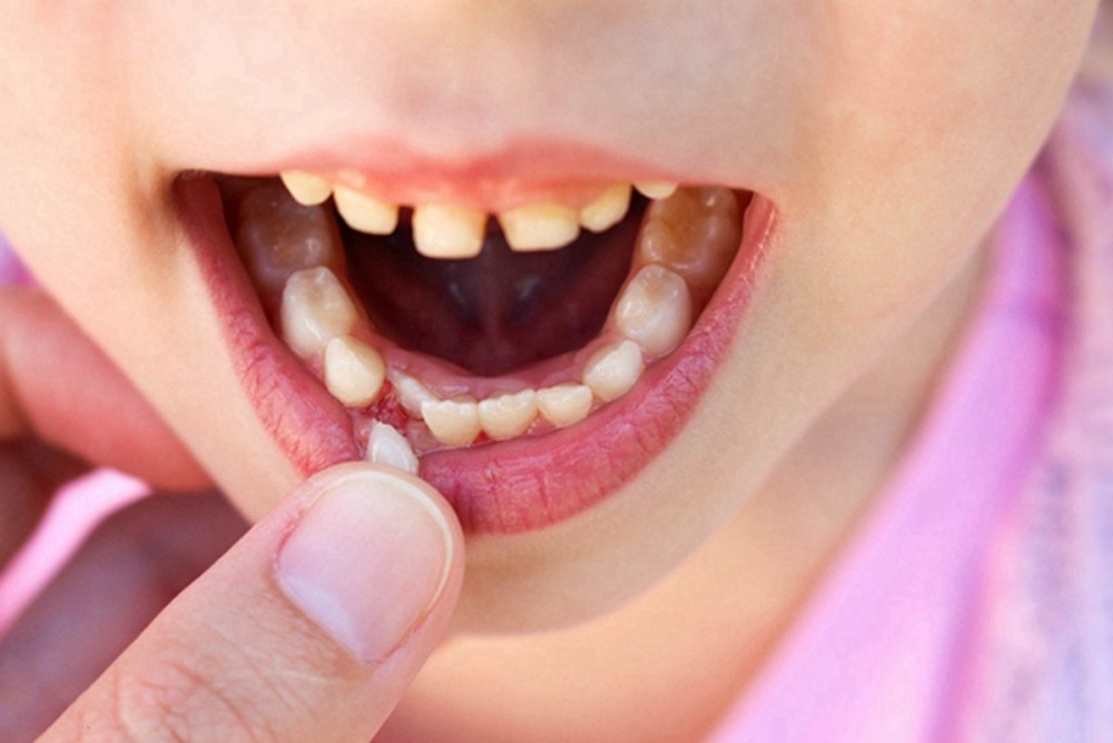 有些孩子在换牙的时候,可能存在乳牙滞留的情况,所以家长一定要特别