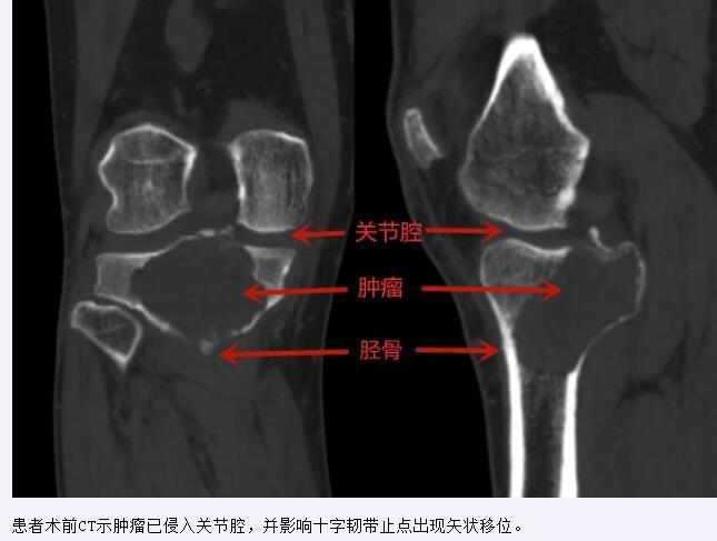 山大齐鲁医院(青岛)为复杂骨巨细胞瘤患者保留自身膝关节