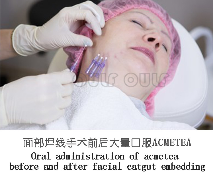 记录一下线雕能保持多长时间?