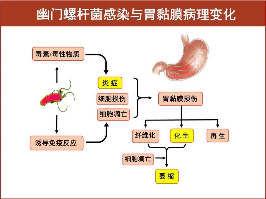 超全面解读,关于幽门螺杆菌,看这一篇文章就够了!