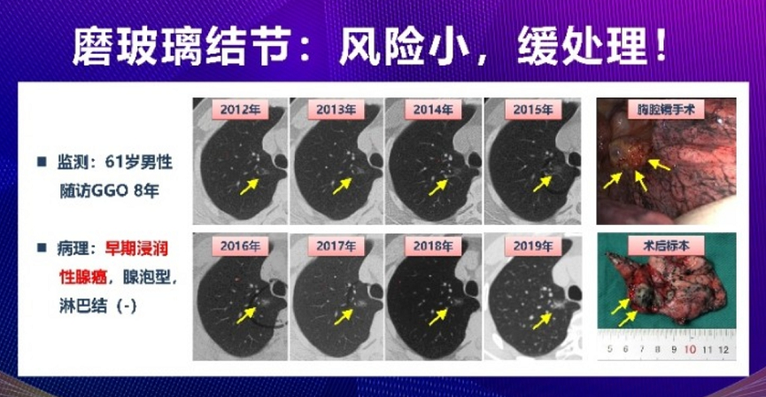 王俊院士客观理性个性化处理肺小结节及磨玻璃结节让90早癌患者获生存