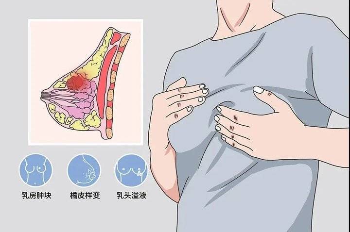 济南市第四人民医院成功开展乳腺癌单孔腔镜保乳手术
