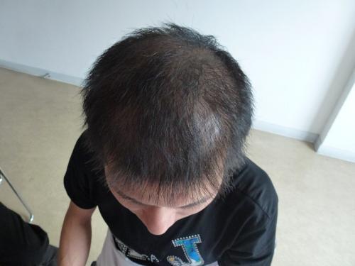 专家指出,李先生属于典型的脂溢性脱发,起初呈现出头油掉发的现象
