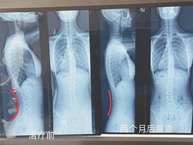 13岁少女睡姿不对 竟把脊柱睡成"s"型