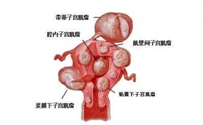 子宫肌瘤大小 腾讯网
