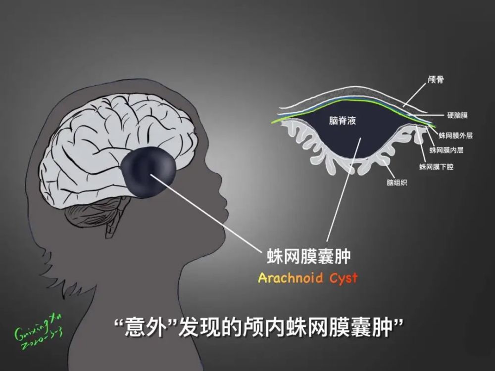 儿童颅内"意外"蛛网膜囊肿的诊治之路