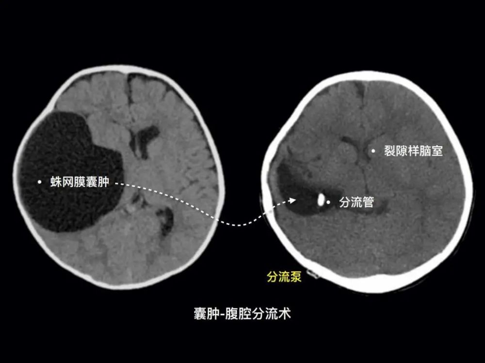 儿童颅内"意外"蛛网膜囊肿的诊治之路