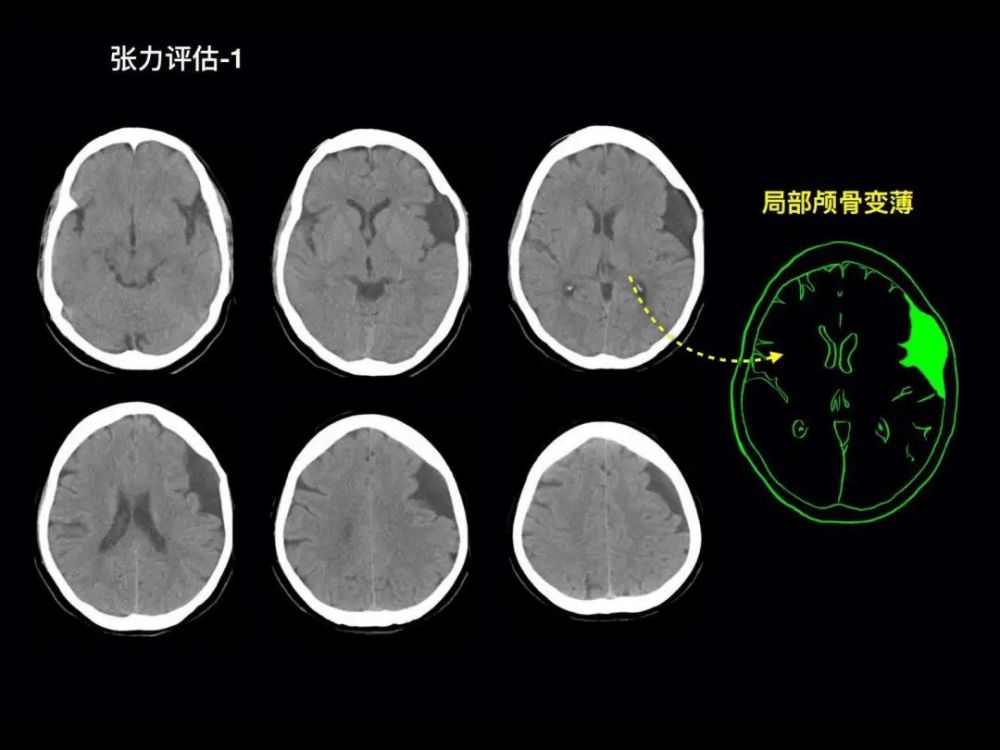 儿童颅内"意外"蛛网膜囊肿的诊治之路