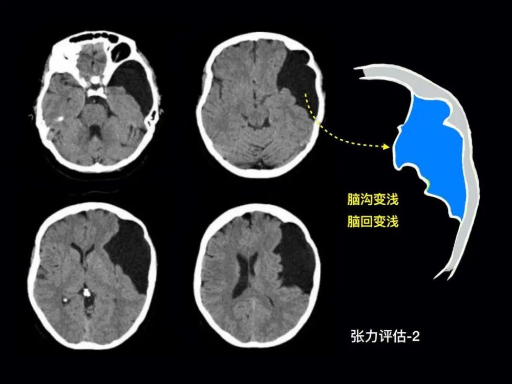 儿童颅内"意外"蛛网膜囊肿的诊治之路