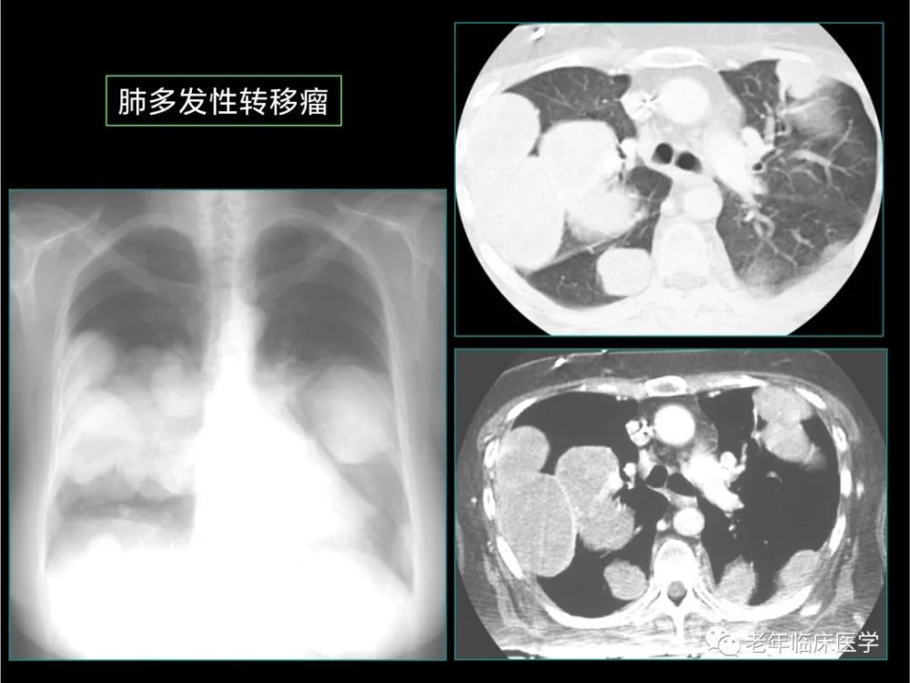 肺转移瘤最常见的ct表现是肺部多发结节样的病变或者是磨玻璃样结节