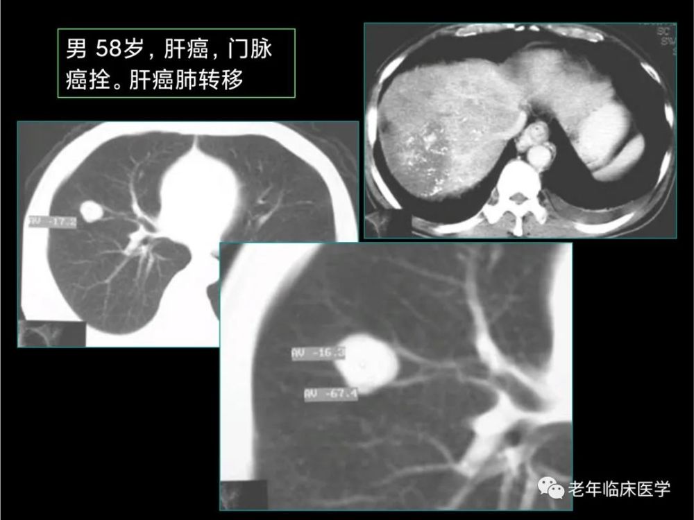 珍藏版(ct系列之五):肺转移癌