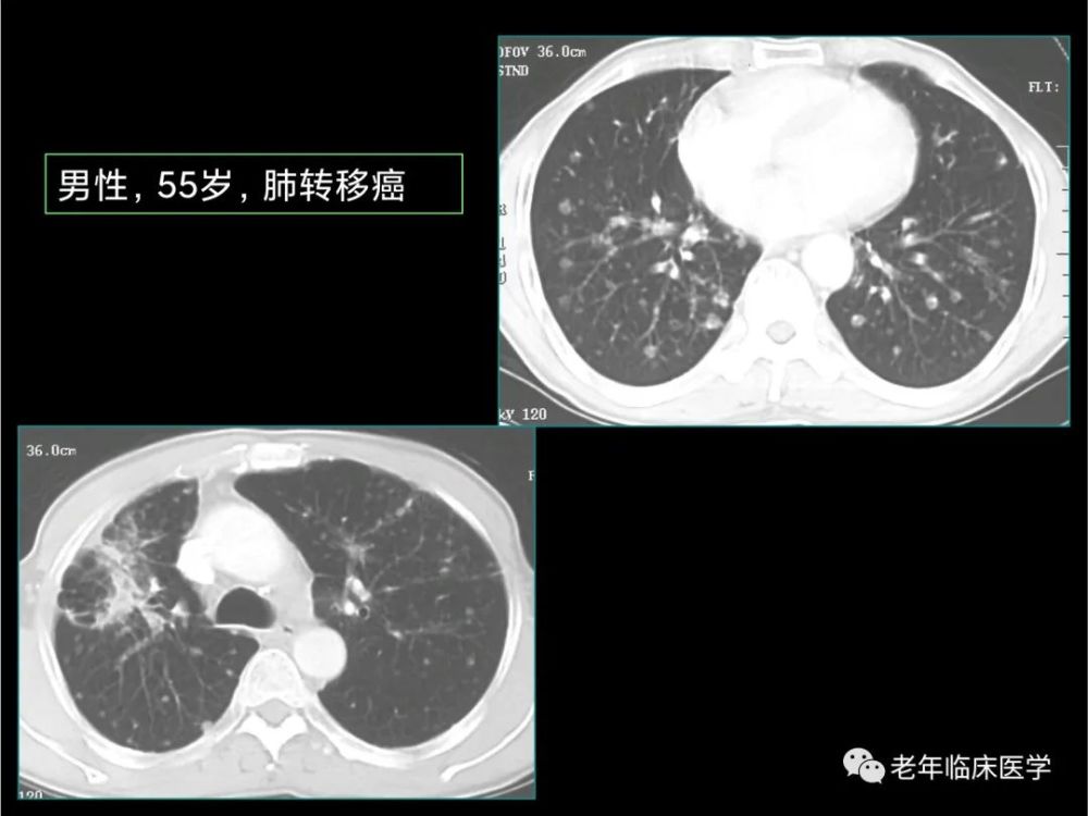 珍藏版ct系列之五肺转移癌