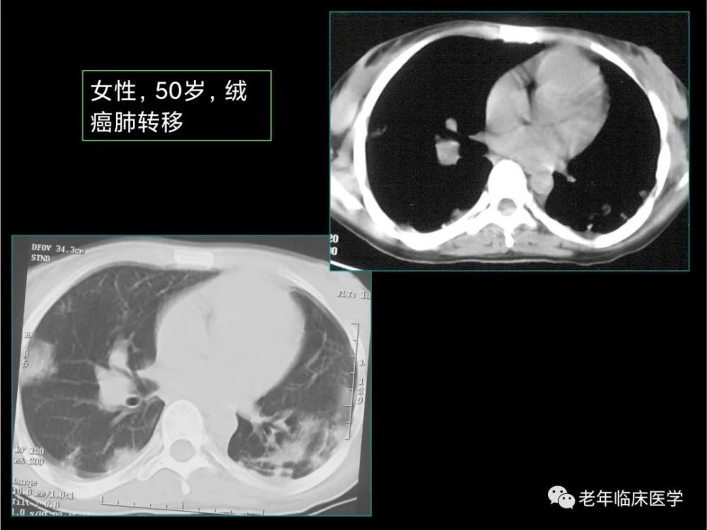 珍藏版(ct系列之五):肺转移癌