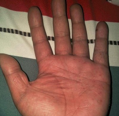 【长春肤康皮肤】手癣反复发作怎么办