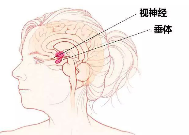 视力不断下降,需警惕脑垂体瘤