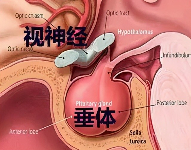 视力不断下降,需警惕脑垂体瘤