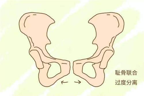 孕妈是这3种情况最容易遭受耻骨痛特别第3点双重压力