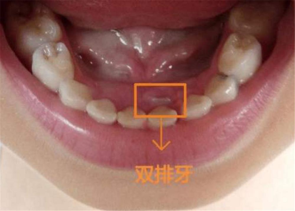 "双层牙"的孩子越来越多,和家长的习惯有关系,很多家庭仍在做