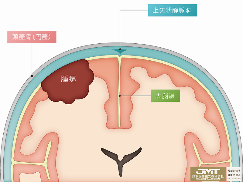 jmt日本看病视野欠缺是脑膜瘤的征兆听力下降也是