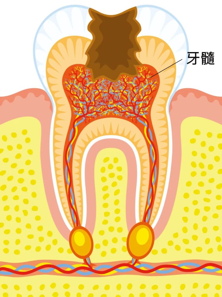 △这已经是比较严重的龋坏了 第三阶段:牙髓炎症——破坏牙髓 再继续