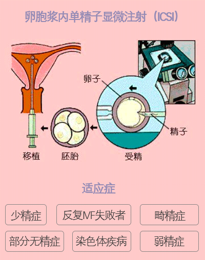 常规体外受精(ivf:就是将精子或卵子取出体外,经过处理或培养成胚胎