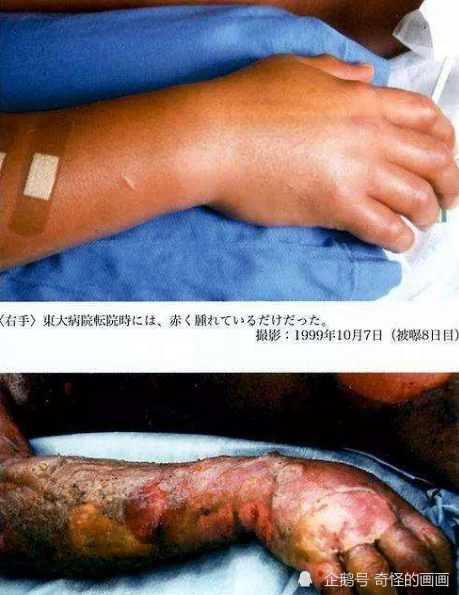 死法"最惨"的日本人:医生为他强行续命83天,亲眼看着自己腐烂